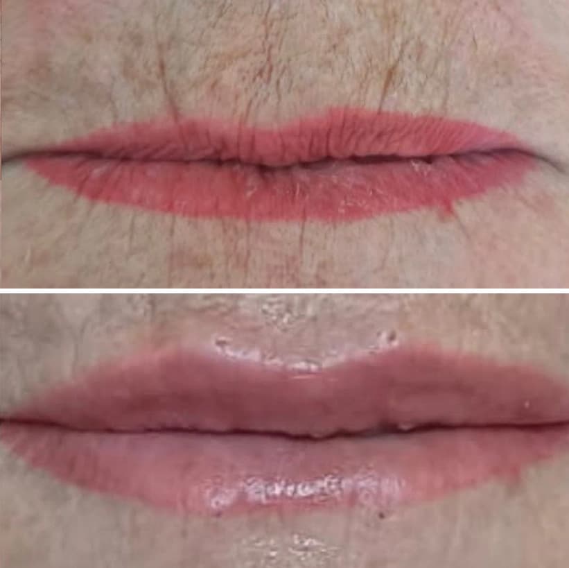 Antes e depois de um tratamento labial