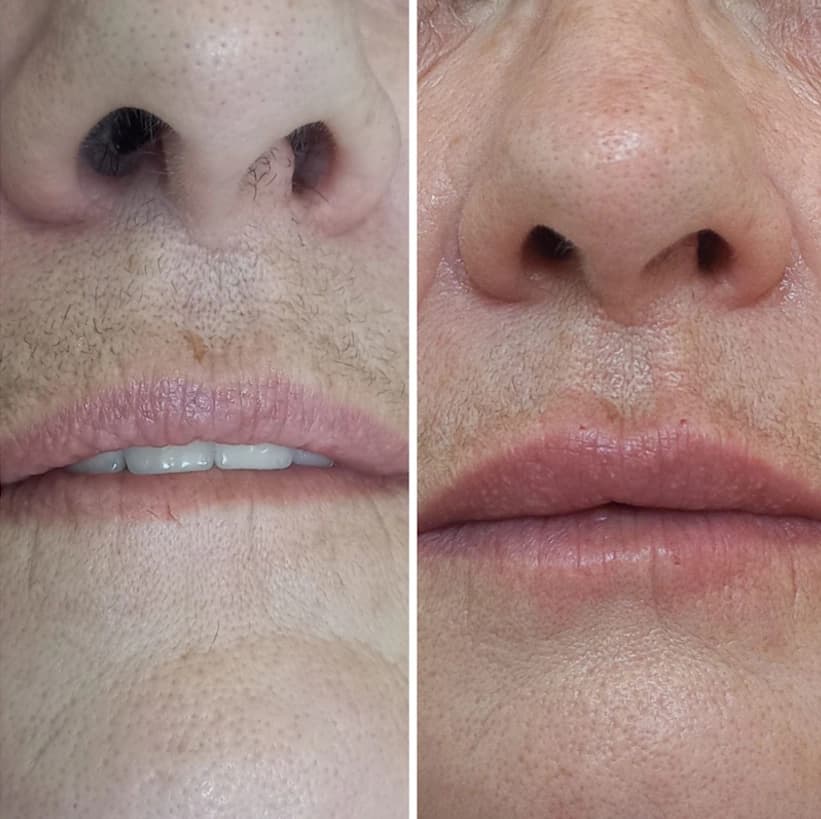 Depois — Resultado real