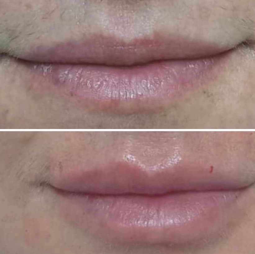 Antes e depois de um tratamento odontológico, focando nos lábios.